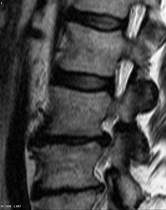 Osteochondrose T2